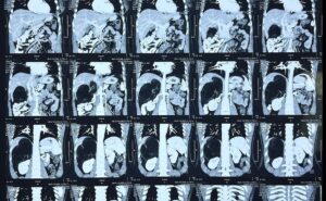 The world’s largest adrenal tumor robotic removed at Delhi Hospital